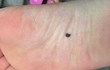 'Nốt ruồi' này trên cơ thể đứa trẻ có nghĩa là 'may mắn' 