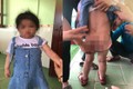 Dì ruột đánh cháu gái nhập viện ở Hà Tĩnh: Có khởi tố vụ án?