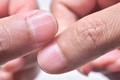 Bàn tay xuất hiện 5 dấu hiệu này chứng tỏ mắc bệnh gan