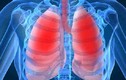 Những triệu chứng phổ biến chứng tỏ bạn bị ung thư phổi