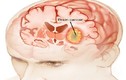 Phân biệt ung thư não với chứng đau đầu thông thường