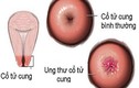 Các loại ung thư cổ tử cung phổ biến