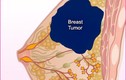 Bốn giai đoạn phát triển của ung thư vú