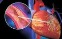 Biểu hiện của bệnh mạch vành