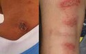 Phân biệt viêm da và nhiễm ký sinh trùng