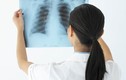 Lao màng phổi kiêng món gì?