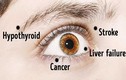 Có thể phát hiện tỷ bệnh nguy hiểm từ các dấu hiệu lạ ở mắt