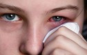 Nguyên tắc chăm con trẻ bị đau mắt đỏ 
