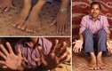 Dị nhân Ấn Độ có 28 ngón tay và chân