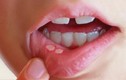Dấu hiệu của ung thư môi bạn không nên coi thường