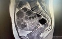 Trì hoãn việc này, bệnh nhân 42 tuổi tử cung  “mọc” u chi chít như sung