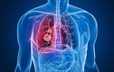 Dấu hiệu bất thường ở chân cảnh báo ung thư phổi, 90% không biết