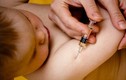 Những hiểu lầm thường gặp về vắc xin ngừa sởi