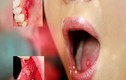 Triệu chứng bất thường nhận biết ung thư môi