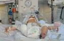 Tháo khớp gối bé sơ sinh văng khỏi bụng mẹ trong vụ tai nạn