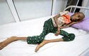 Những bức hình ám ảnh về tình trạng suy sinh dưỡng ở Yemen
