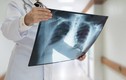 Những dấu hiệu ung thư phổi ít biết bạn chớ nên bỏ qua