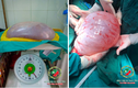 Phẫu thuật thành công cho cô gái 22 tuổi mang khối u buồng trứng gần 8kg 