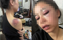 Cô vợ 9X tố chồng bạo hành bầm dập, netizen nhìn mà xót xa