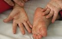 Bệnh tay chân miệng: Chủng virus EV 71 có thể gây chết người