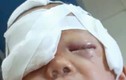 Thái Nguyên: Bé 20 tháng tuổi bị chó nhà cắn rách mặt 
