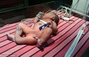 Bé sơ sinh mắc dị tật hiếm: Bẩm sinh đã có 3 chân
