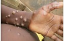 Video: Bệnh đậu mùa khỉ bùng phát, cần lưu ý các triệu chứng gì?
