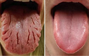 Các dấu hiệu cảnh báo bệnh trên lưỡi