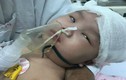 Ngã võng, bé gái 6 tháng tuổi bị chấn thương sọ não nguy kịch
