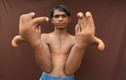 Cậu bé người Ấn Độ có bàn tay “khủng” rất kỳ lạ