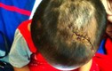 Kinh hãi vết thương trên người bé 3 tuổi nghi bị cha dượng bạo hành