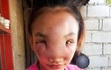 Thiếu nữ 17 tuổi nguy cơ bị mù sau khi nặn mụn trên mũi