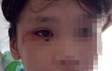 Học trực tuyến 8 tiếng/ngày, bé gái 12 tuổi chảy máu mắt ồ ạt 