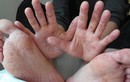 Hà Nội: 10 trẻ mắc tay chân miệng do nhiễm chủng EV71