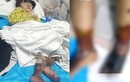 Bé gái 4 tuổi bị “mẹ kế” rót nước sôi bỏng cả hai chân