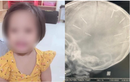 Bé gái bị 9 đinh găm vào đầu ở Hà Nội: Bác sĩ nói gì?