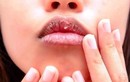 Những dấu hiệu ở miệng giúp "tiên đoán" ung thư gan