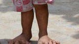 Bệnh lạ: Bé gái 3 tuổi mắc bệnh “bàn chân voi“