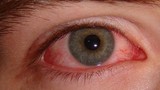 Những biến chứng đáng sợ của đau mắt đỏ