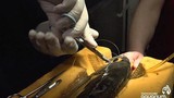 Xem phẫu thuật thay mắt cá bị đục thủy tinh thể