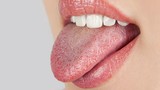 Video: Tự chuẩn bệnh chính xác 90% chỉ cần nhìn màu lưỡi