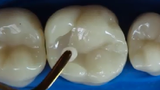 Tường tận quy trình nha sĩ biến răng sâu thành răng đẹp