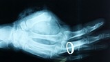 Nối ngón tay thành công cho một bệnh nhân ở Nghệ An