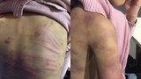 Hà Nội: Bé gái 12 tuổi nghi bị mẹ đẻ bạo hành, người tình của mẹ hãm hiếp
