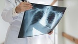 Những dấu hiệu ung thư phổi ít biết bạn chớ nên bỏ qua