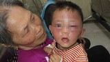 Kinh hoàng bé 2 tuổi bị cha dượng đánh tím bầm mặt