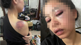 Cô vợ 9X tố chồng bạo hành bầm dập, netizen nhìn mà xót xa