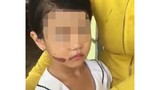 Thêm tình tiết mới trong vụ bé gái nghi bị bạo hành ở Kiên Giang