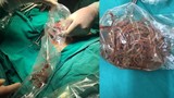 Phú Thọ: Mổ cấp cứu lấy búi giun khoảng 100 con cho bệnh nhi 11 tuổi