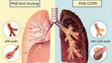 Mắc căn bệnh này chẳng khác nào ung thư phổi